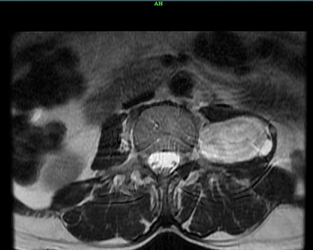 laparoscopic-removal-of-lumbar-paraspinal-schwannoma--dr-pavan-kumar-thumbnail
