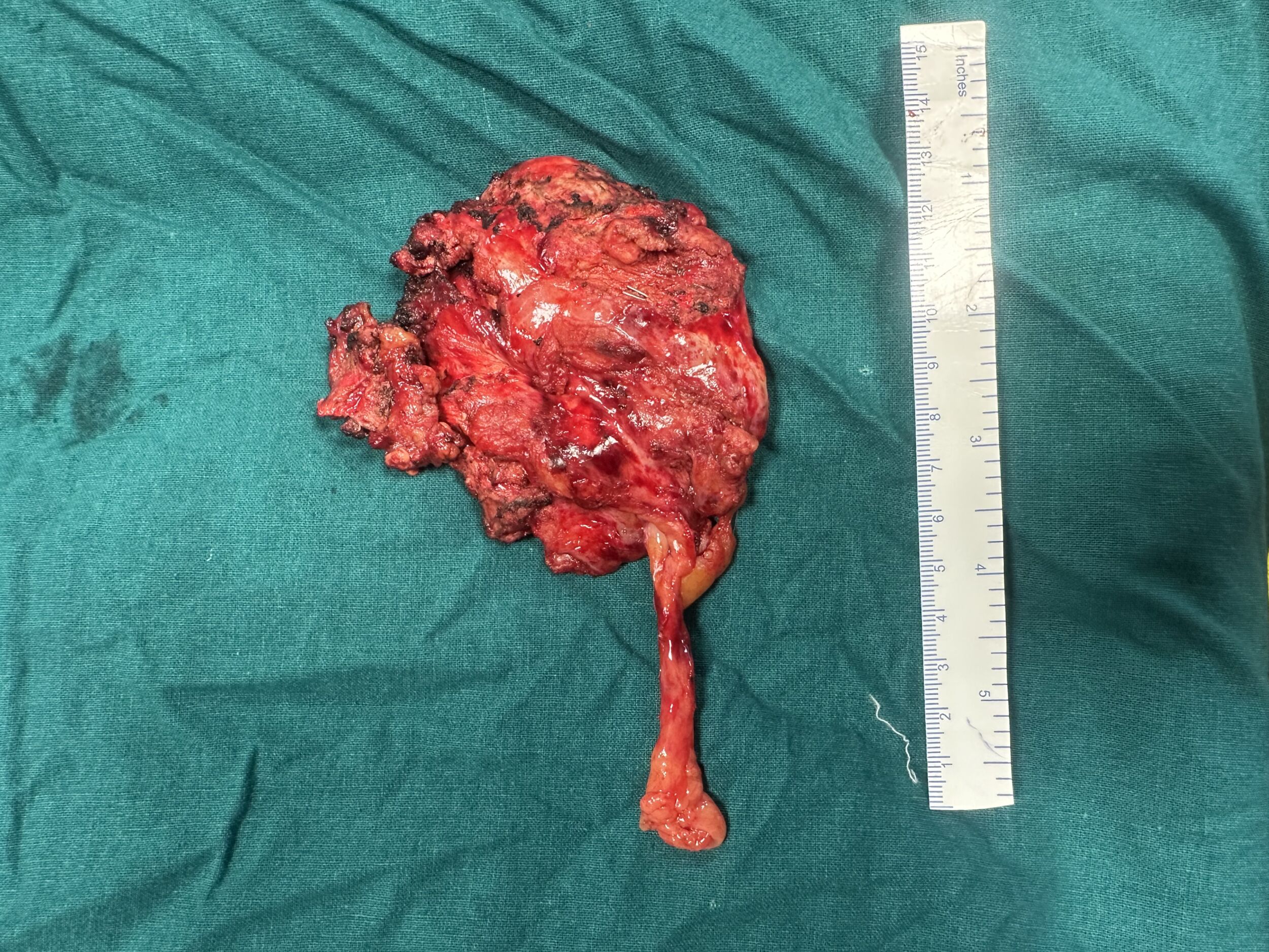 surgical-management-of-mediastinal-germ-cell-tumor-image