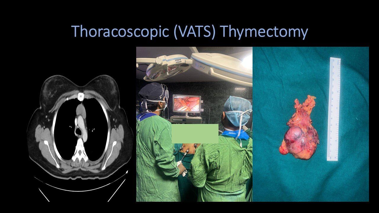 Thoracoscopic (VATS) Thymectomy for Thymoma | Dr Pavan Kumar