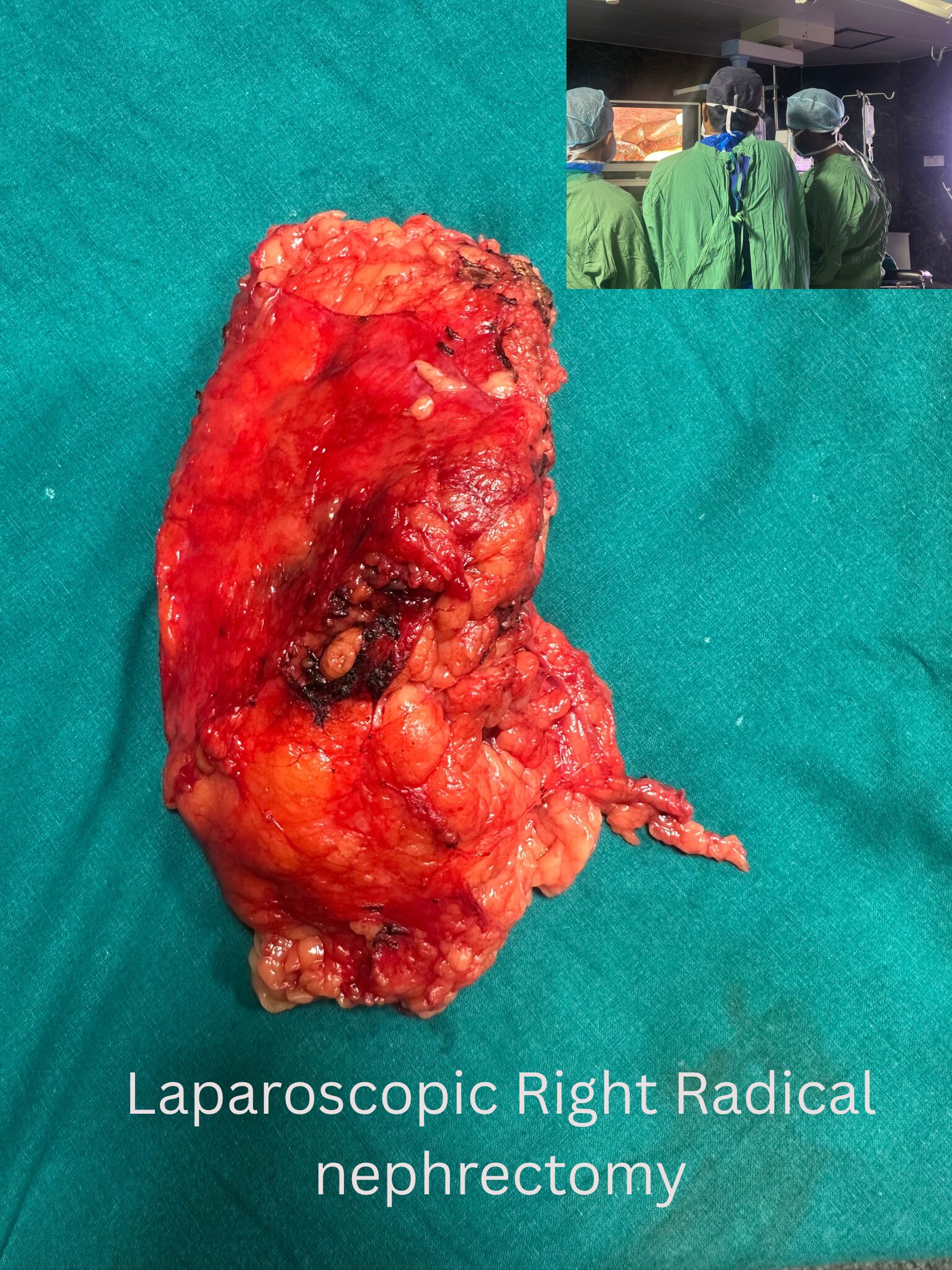 laparoscopic-right-radical-nephrectomy-for-renal-cell-carcinoma-image