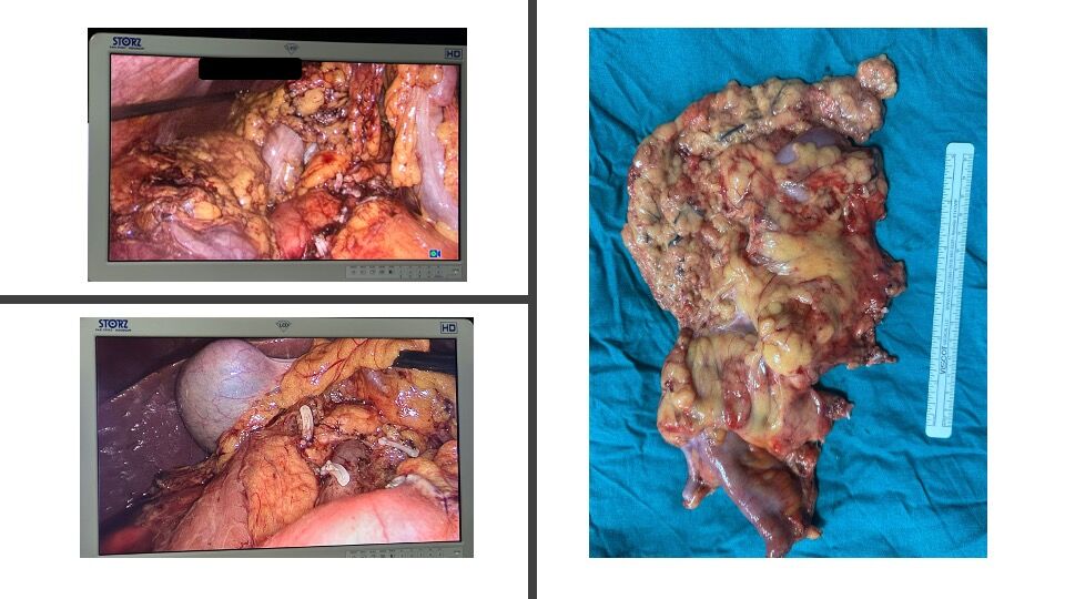 Laparoscopic Right Radical Hemicolectomy with D3 Lymphadenectomy (Central Vascular Ligation)