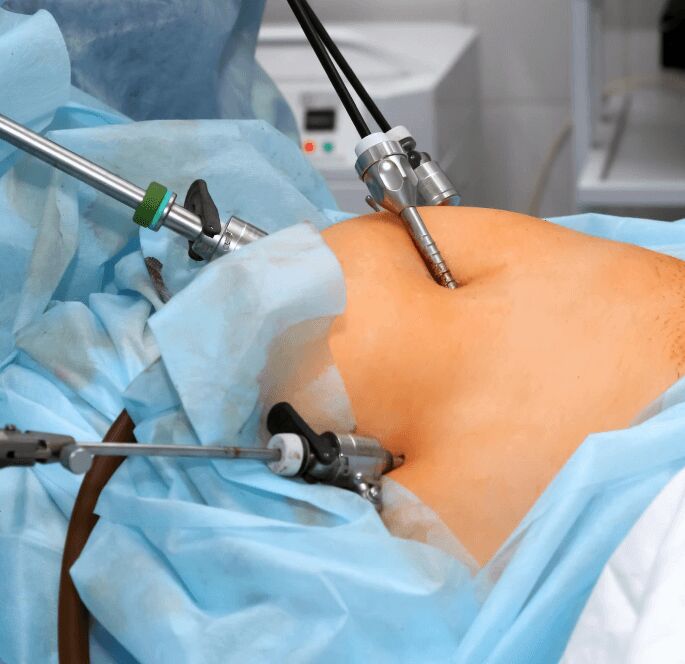 From Frailty to a New Beginning: The Impact of Laparoscopic Surgery in Colon Cancer